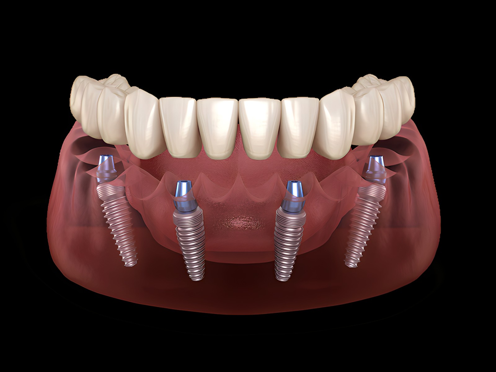 All-On-4® Dental Implants