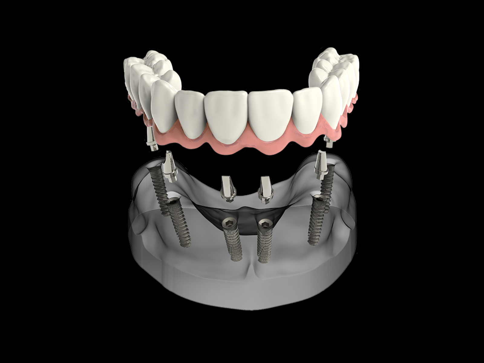 Acrylic Overdenture Solutions