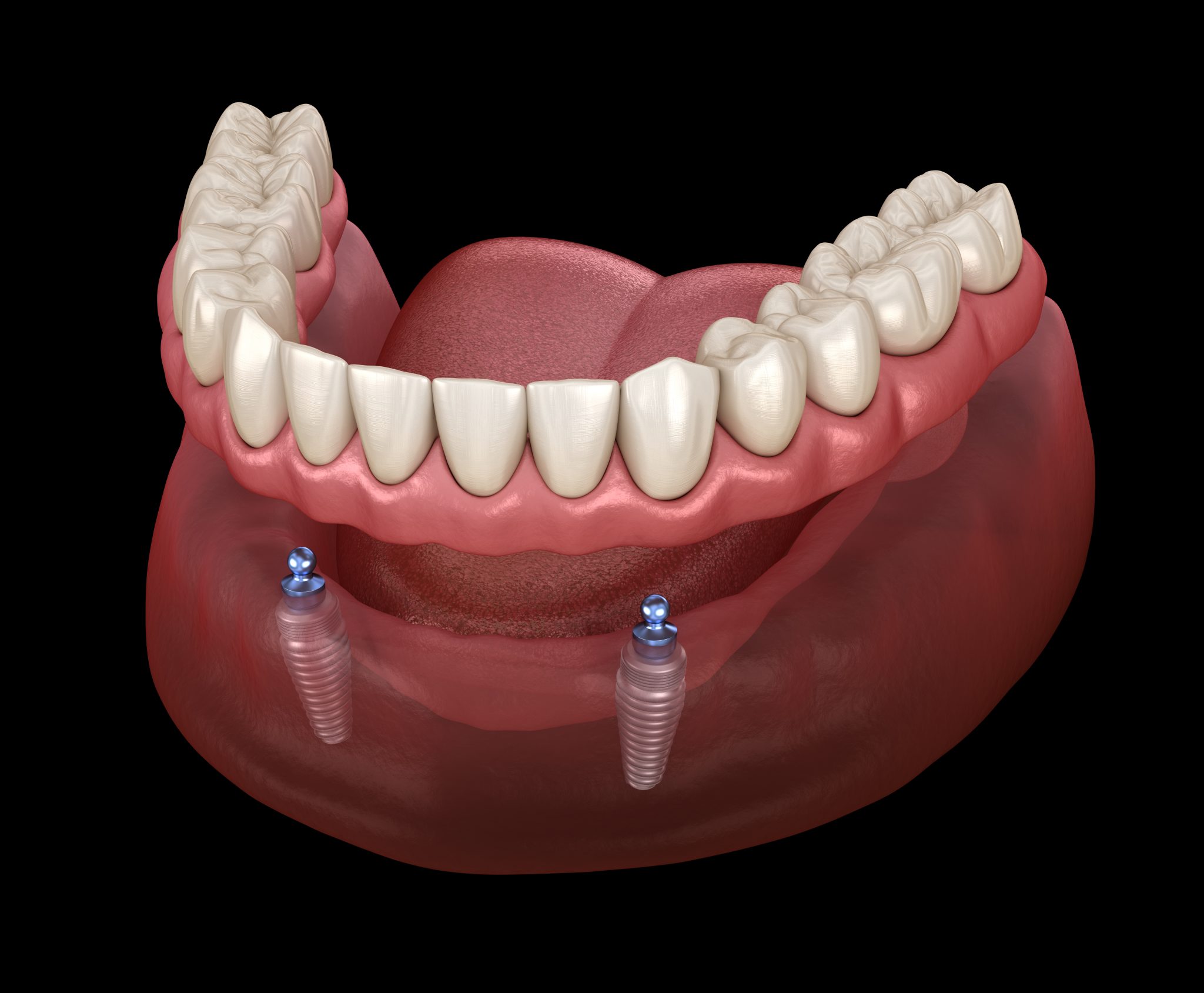 Fixed vs. Removable Solutions